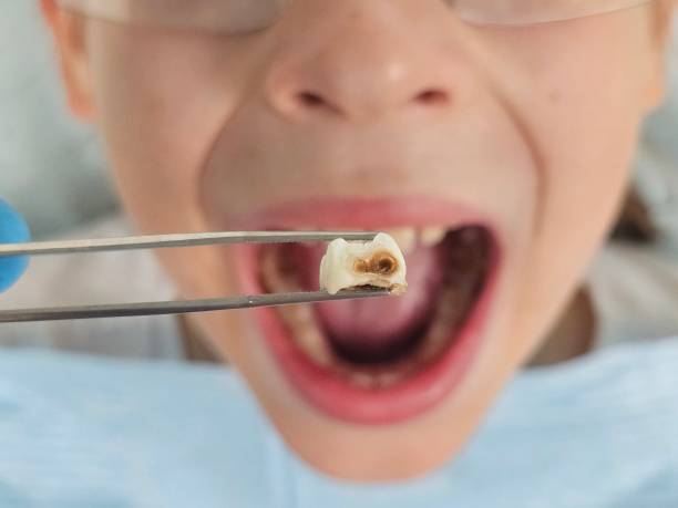 Best Cracked Tooth Emergency Dentist  in Stonegate, CO